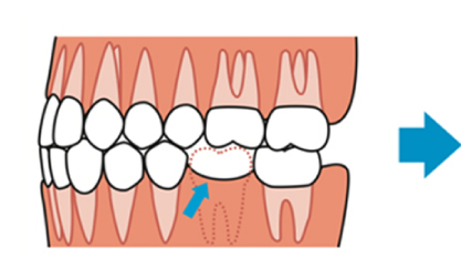 歯並びへの影響