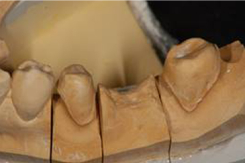 参考例１：奥歯のブリッジ（保険治療）