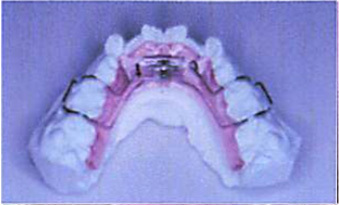 参考例２：前歯のブリッジ（自費治療）