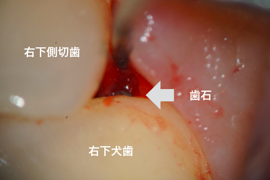歯周病治療（MINST：マイクロスコープを用いた低侵襲な非外科治療 