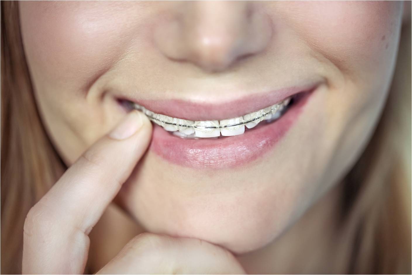 参考例２：前歯のブリッジ（自費治療）